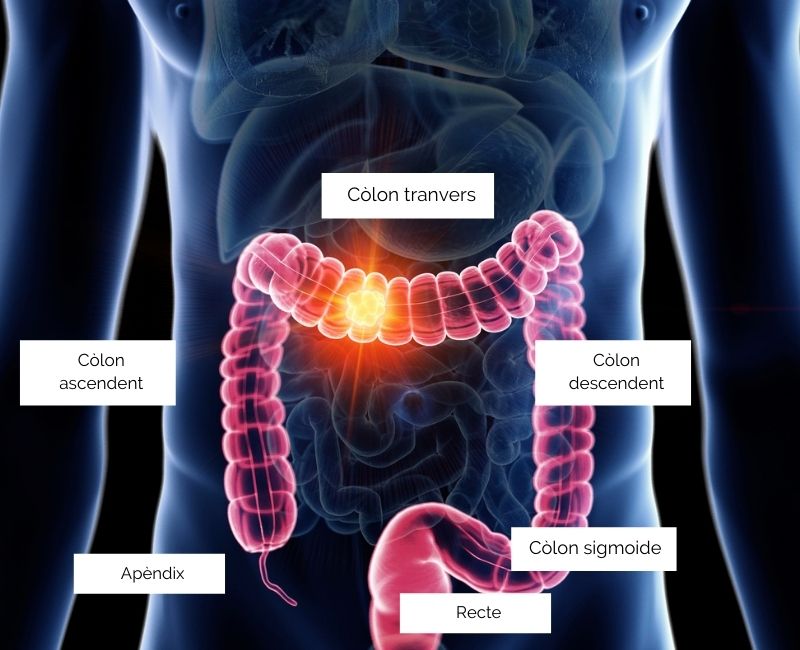 cancer-de-colon-ca