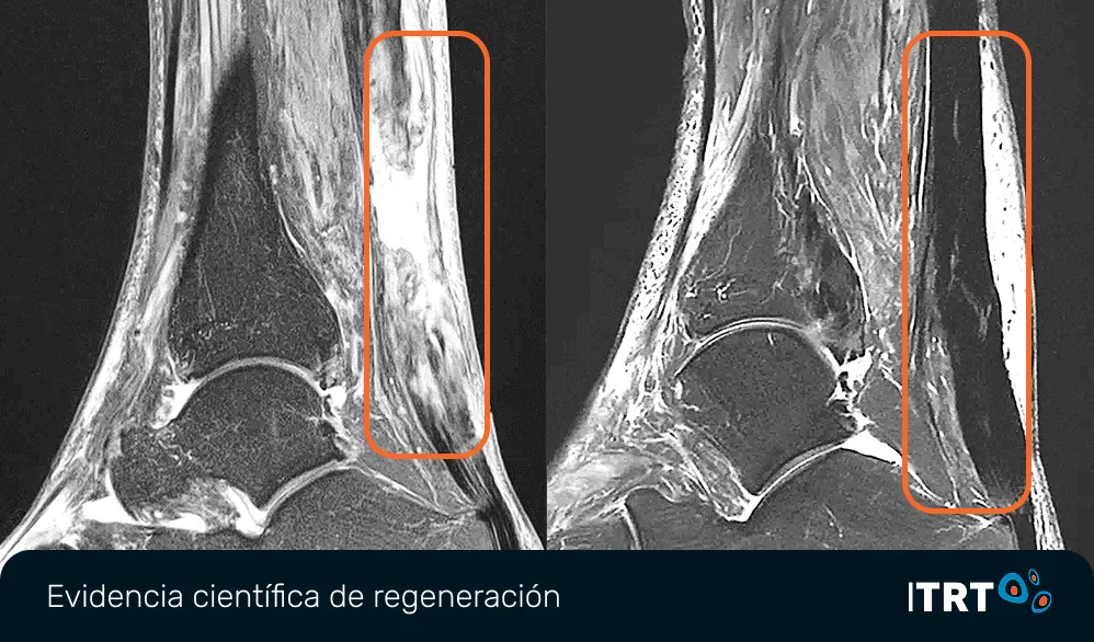 regeneracion-tendon-aquiles