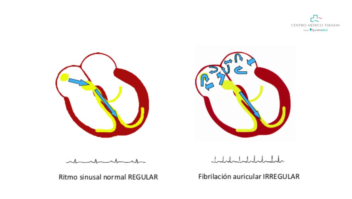 ¿Qué es fibrilación auricular?