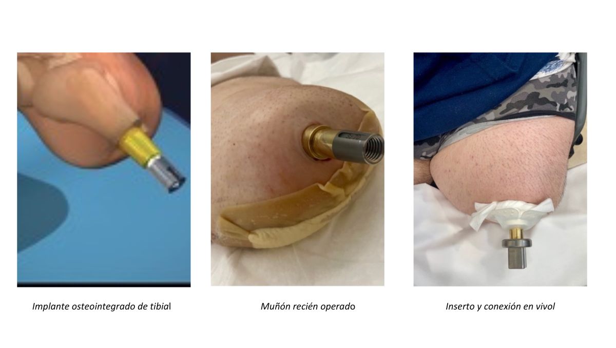 Implante osteointegrado de tibia