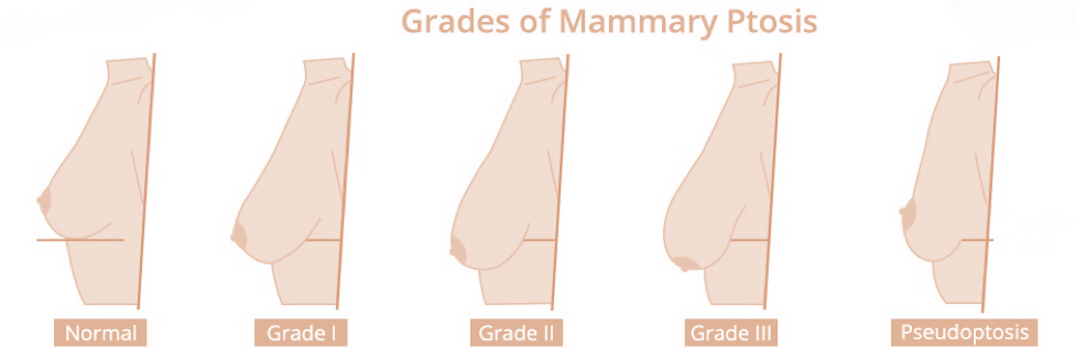 grados-ptosis-instituto-dra-ana-torres-barcelona-1