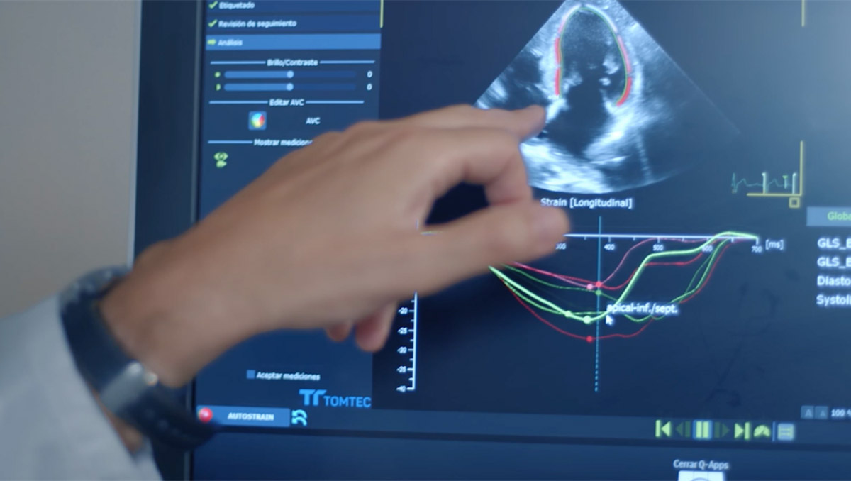 cardio-oncologia-teknon