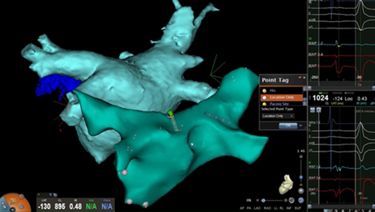 Arritmias-blog-teknon