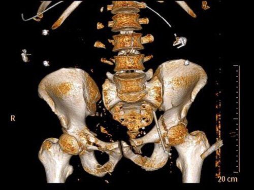 Resonancia de cadera