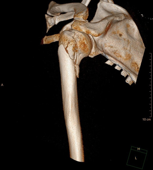 Desintometría ósea