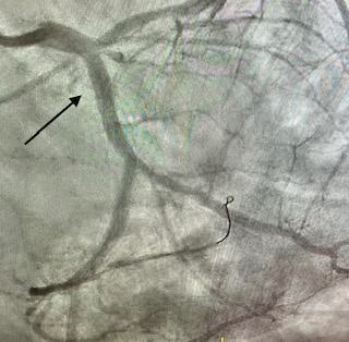02-angioplastia-con-stent