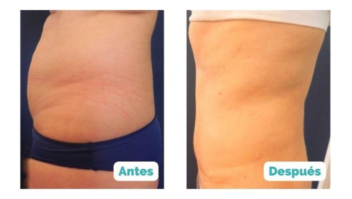 abdominoplastia-teknon