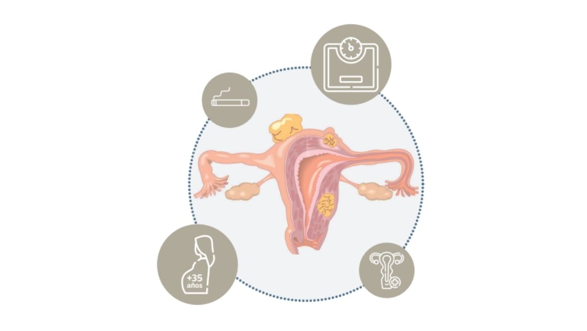 Factores de riesgo cáncer de ovario