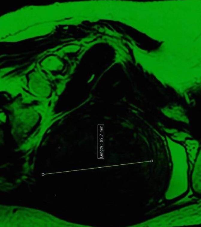 2Miomas-teknon-dr-nadal