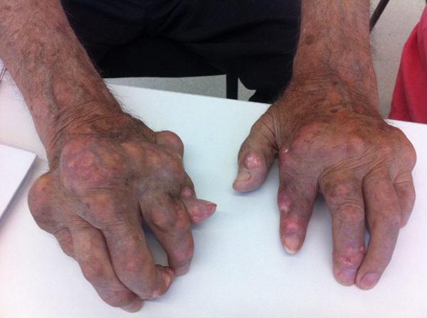Aspecto de manos de un paciente con gota. Este enlace se abrirá en una ventana nueva