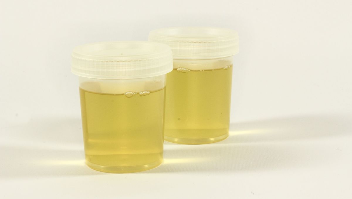 test-orina-cestitis-teknon-barcelona