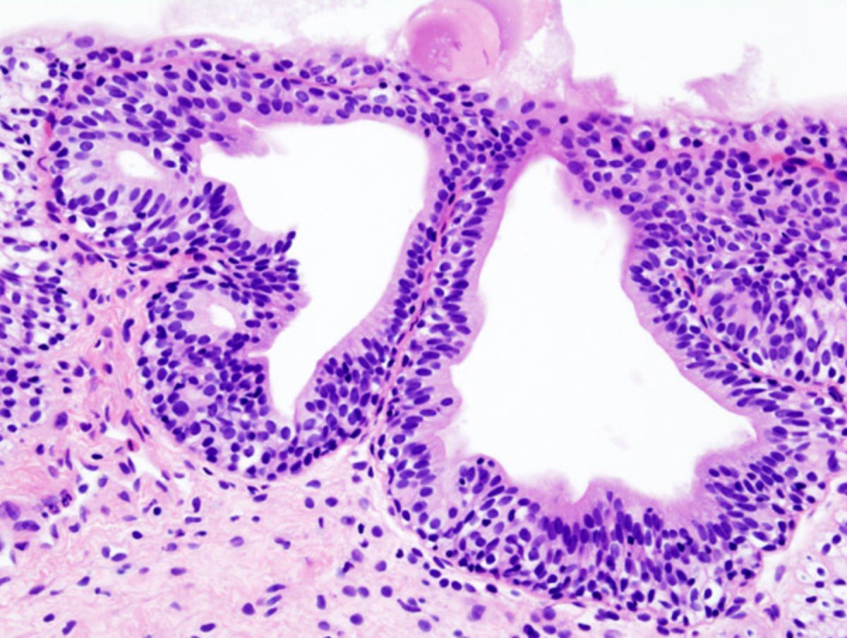 Cystitis_glandularis_at_trigone