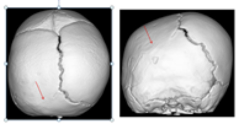 craneosinostosis-teknon