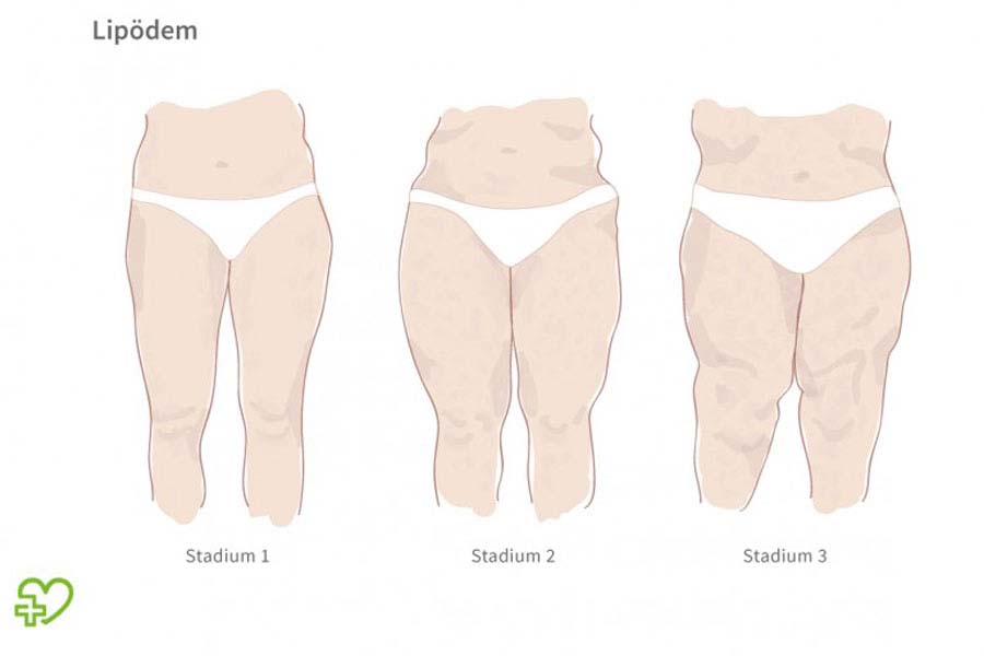 lipedema-estadios Ana Torres