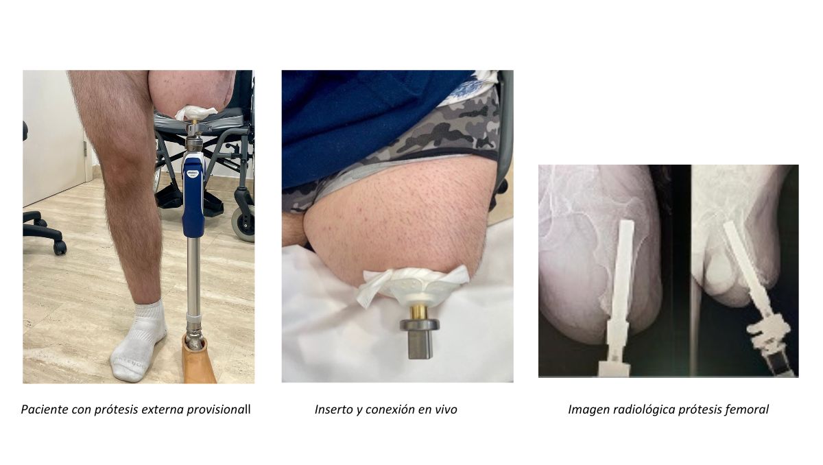 Prótesis de titanio