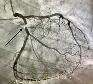 01-angioplastia-con-stent