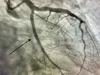 04-angioplastia-con-stent-infarto