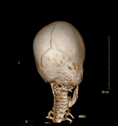 Craneosinostosis paciente del Instituto de neurocirugía NeuroSpinal Institute Barcelona en el Centro Médico Teknon