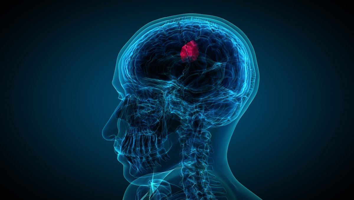 Tumor cerebral
