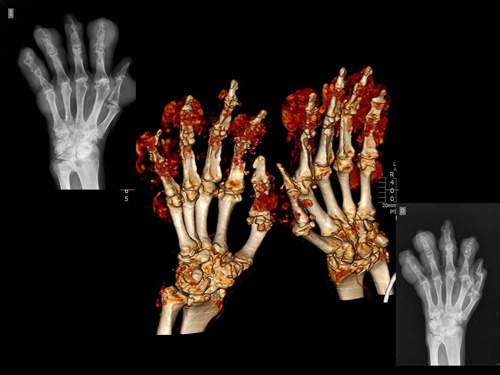 Resonancia de manos con Gota y manos sin Gota