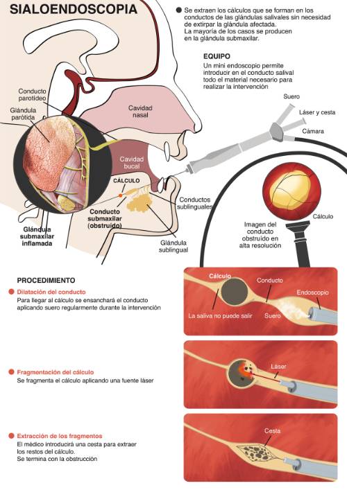 sialoendoscopia_nuevo