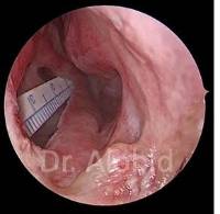 Perforación_Dr. Isam Alobid_CM Teknon