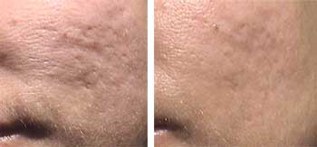 acne-2