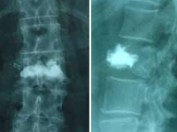 Cifoplastia_06
