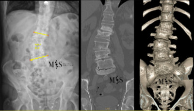 preop-scoliosis