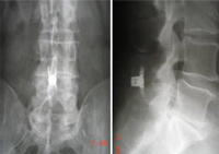 implantes5