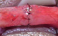Sutura muscular