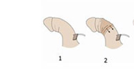 Corporoplastia de Nersbit