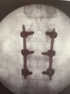 Artrodesis Lumbar 1
