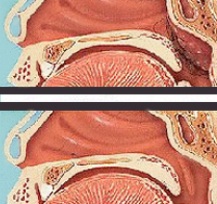 Adenoidectomía