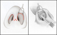 Rinoplastia2