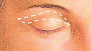 Blefaroplastia-después