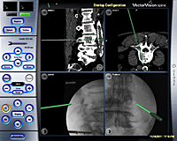 Fijación vertebral guiada con navegación_1