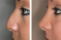 Rinoplastia_02