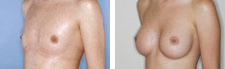 Mamoplastia_02