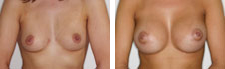 Mamoplastia_04