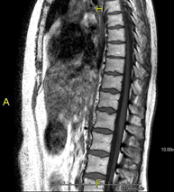 RM Columna dorsal + lumbar