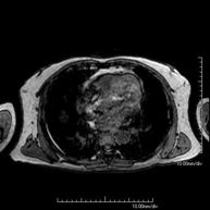 RM de Paret Toràcica