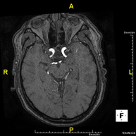 Angio-RM Intracraneal