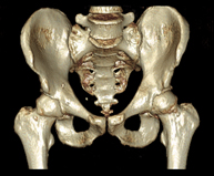 TC Pelvis ósea