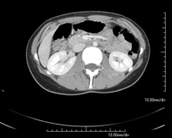 TC Abdomen_ped