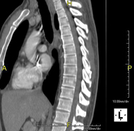 TC Columna dorsal