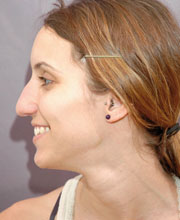 Cirurgia_estetica_testimoni_dona_abans