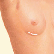 Senos-aumento-mamario