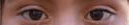 estrabismo_2