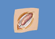 Hernioplastia según la técnica de rutkow-Robbins_3